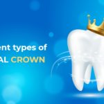 different types of dental crown