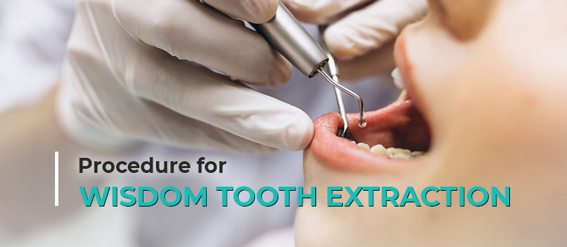 Procedure for Wisdom Tooth Extraction