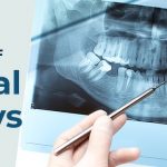 Myths and Realities of Dental X-Rays