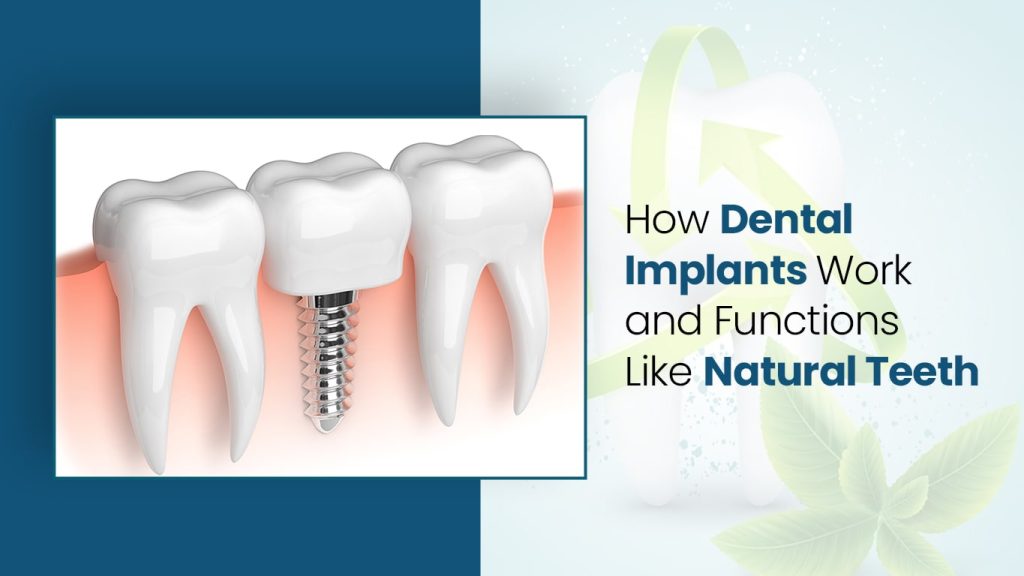 How Dental Implants Work and Functions Like Natural Teeth