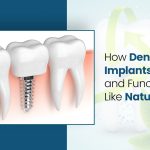 How Dental Implants Work and Functions Like Natural Teeth