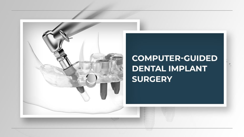 Computer-Guided Dental Implant Surgery