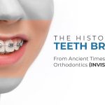 The History of Teeth Braces: From Ancient Times to Modern Orthodontics (Invisalign)