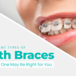 Teeth-Braces-