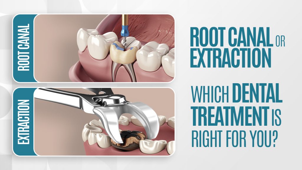 Root Canal or Extraction: Which Dental Treatment Is Right for You?