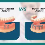Implant Supported Dentures Vs Implant Secured Dentures Explained
